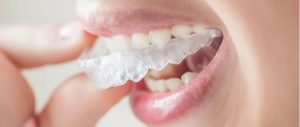 Ouderling kralen Stam Plaatsen onzichtbare beugel: orthodontische ervaring is belangrijk -  TandartsPraktijk