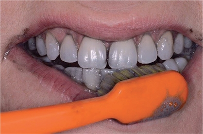 Witte tanden: feit of fictie? -