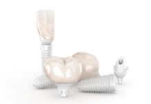 Berisping voor tandarts om ondeugdelijke implantaten