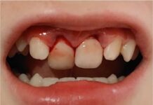 Titanium traumaspalk bij horizontale wortelfracturen | TP Kennistoets Frontaal beeld van mond van kind na het ongeval.