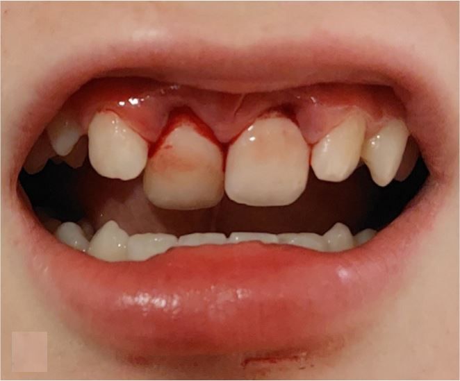 12496_2026_822_Fig8_HTML Frontaal beeld van mond van kind na het ongeval.
