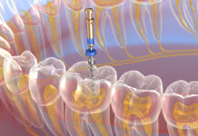 Digitale tandheelkundige procedure voor wortelkanaalbehandeling.