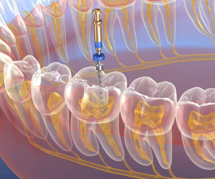 Endodontische behandeling in de tandartspraktijk Digitale tandheelkundige procedure voor wortelkanaalbehandeling.
