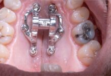 Custom MARPE bij een te smalle bovenkaak Intra-operatieve foto toont chirurgische plaatsing van minischroeven (TADs) op harde verhemelte ter voorbereiding van MARPE-montage. De afbeelding demonstreert exacte positie van TADs lateraal van mediopalatale sutura op divergentie van 15-30 graden. Deze bilaterale plaatsing garandeert symmetrische, orthopedische expansie