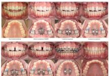 Airway orthodontics: trend of nieuwe standaard? Intraorale foto’s voor, tijdens en na behandeling met de MARPE.