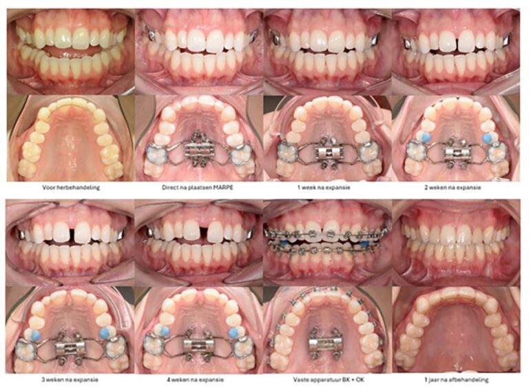 Airway orthodontics: trend of nieuwe standaard? Intraorale foto’s voor, tijdens en na behandeling met de MARPE.