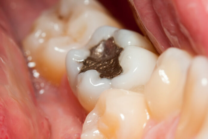 Amalgam filling Beeld van een kies met amalgaam vulling