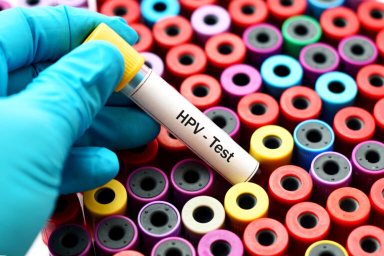 Mondzorg nog nauwelijks betrokken bij HPV-gerelateerde kanker HPV-test buis met testbuisjes voor HPV screening.